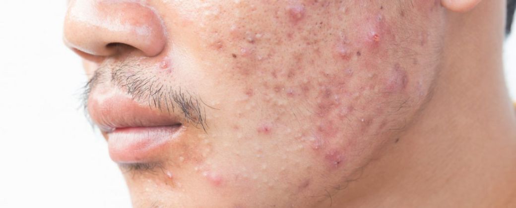 El acné puede presentarse en todas las etapas de la vida. Créditos: The Harley Street Dermatology Clinic