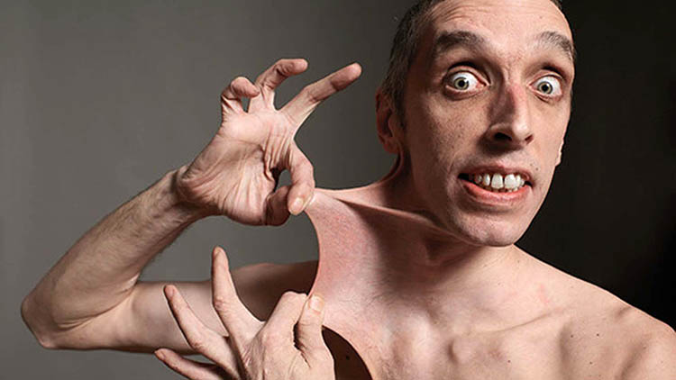 El hombre más elástico del mundo, estiró la piel de su estómago 15.8 cm para batir un récord Guinness en 1999