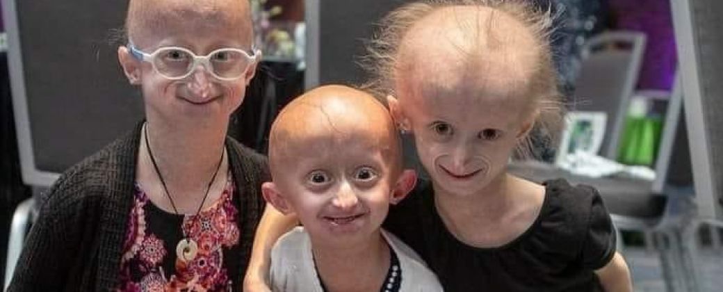 El 90% de los niños con progeria enfrenta problemas de corazón antes de los 15 años. Crédito: Enseñame de ciencia.