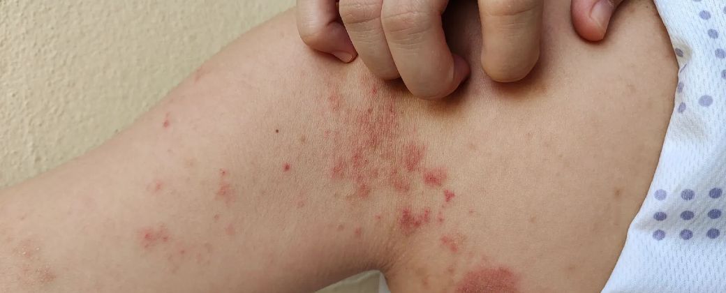 Se notifican alrededor de 200 mil casos nuevos de lepra al año en todo el mundo. Créditos: Página 12.