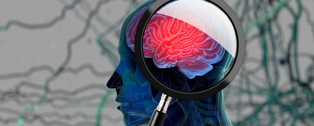 Parkinson Principal Los agregados de alfa-sinucleína son los que logran eliminar a las neuronas productoras de dopamina y generan los síntomas de la enfermedad de Parkinson (imagen: Infobae).